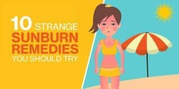 10 Strange Sunburn Remedies You Should Try