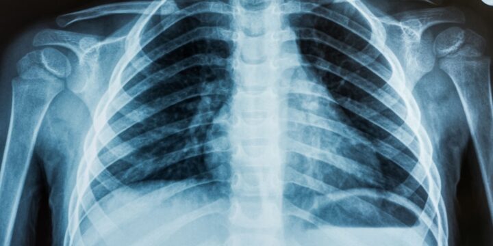OTD in 1896: College students illegally produced America’s first X-ray photo.