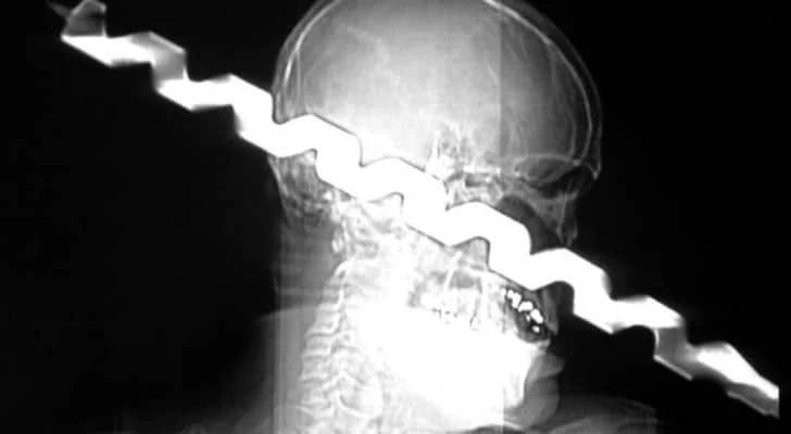 An X-Ray of a drill going right through someones head
