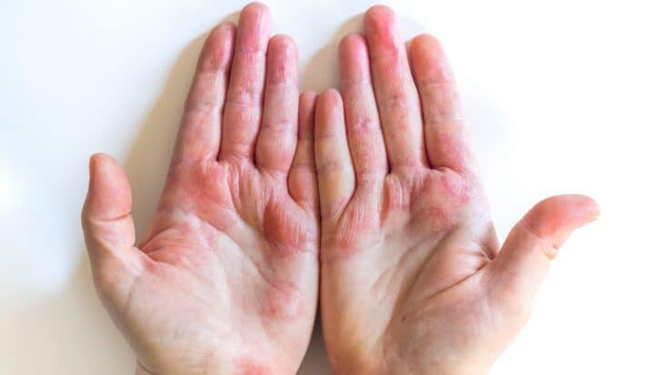 Hands with visible redness and irritation on the skin