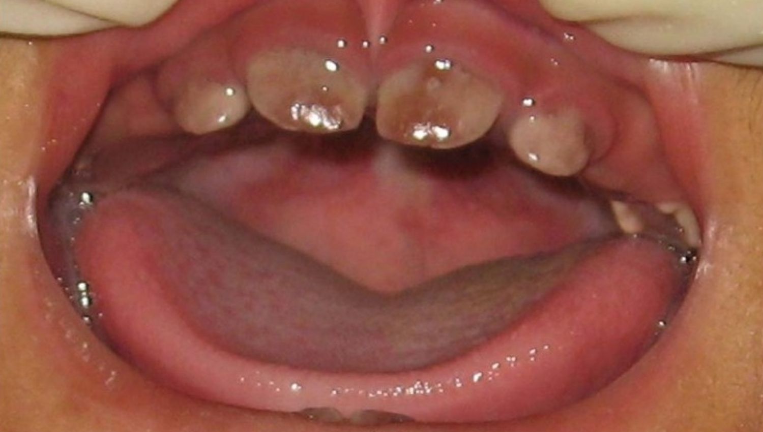 open mouth showing the pointed teeth of someone who suffers from porphyria