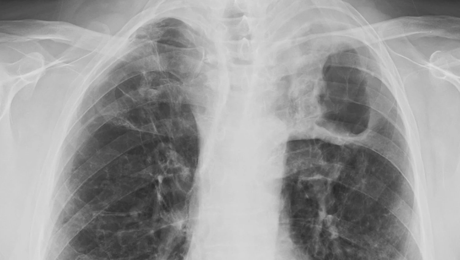 An xray showing tuberculosis in a patient's lungs